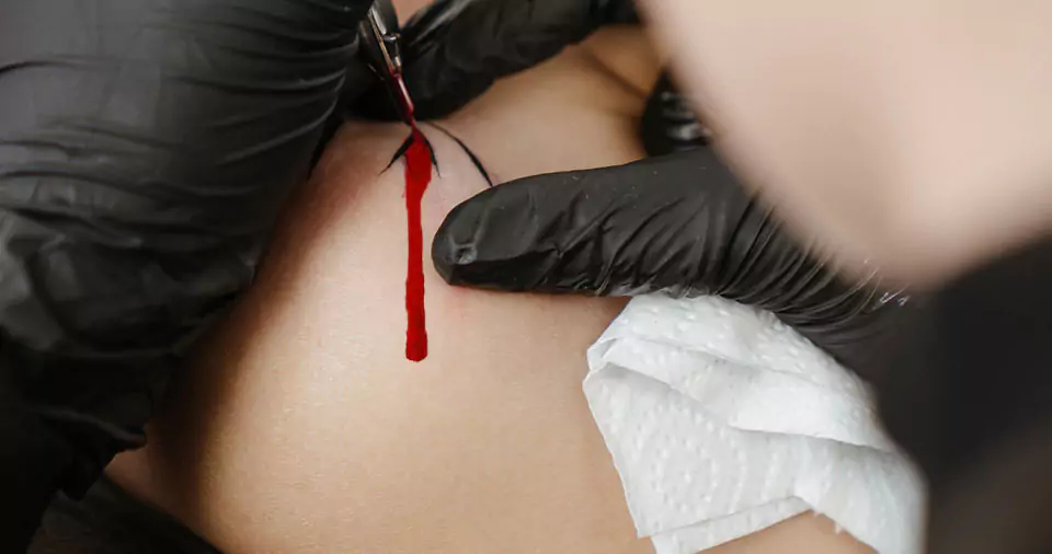 How to get excess tattoo ink off skin