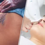 What hurts more tattoo or laser hair removal