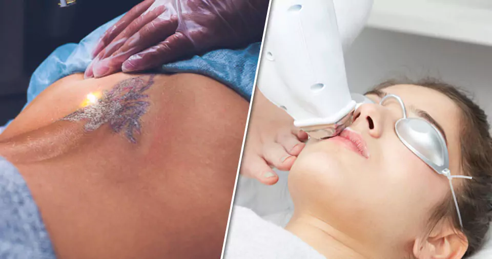 What hurts more tattoo or laser hair removal