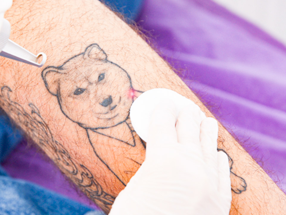 Can I get laser hair removal over a tattoo