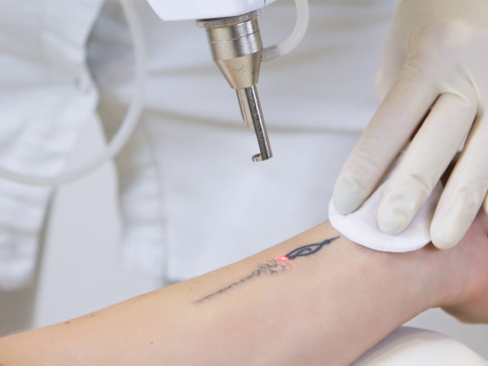 Is laser removal permanent