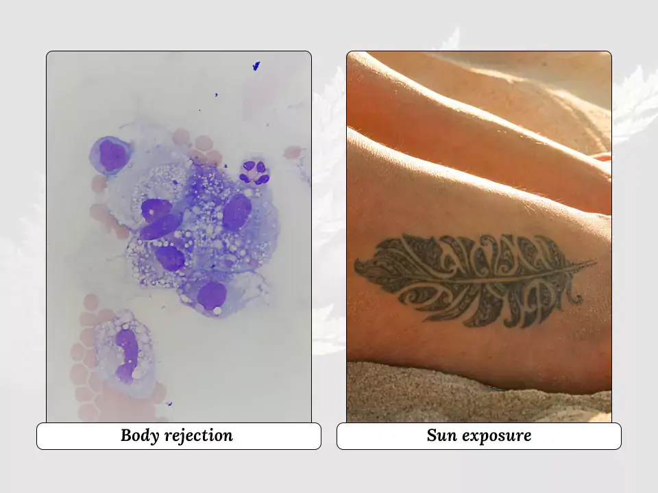 Why are older tattoos easier to remove