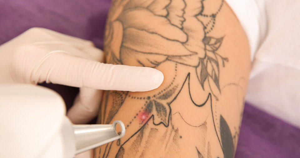 Do-Older-Tattoos-Removed-Easier