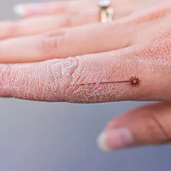 Skin losing hydration