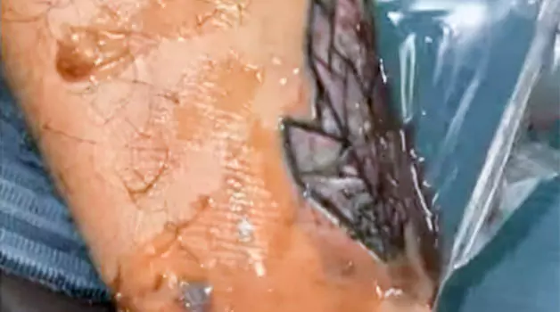 Tattoo ink sack removal