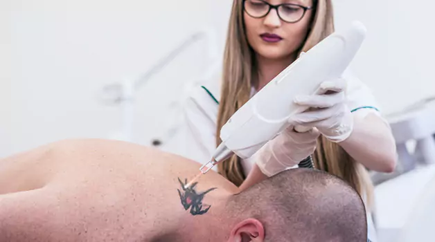 Best way to lighten tattoo: Laser removal