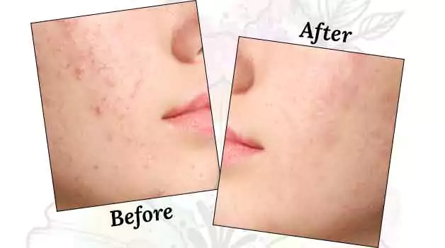 Accutane What it does to the body