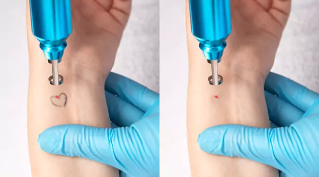 Before and after photos of laser tattoo removal