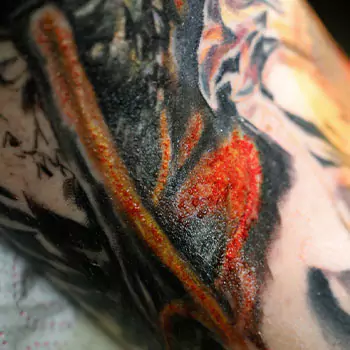 Fresh wound and oozing