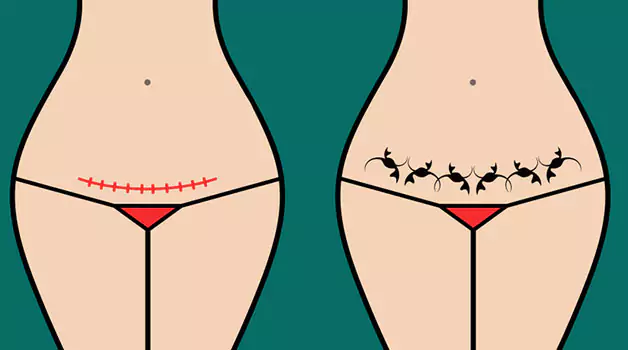 Getting a tattoo on a cut or scar