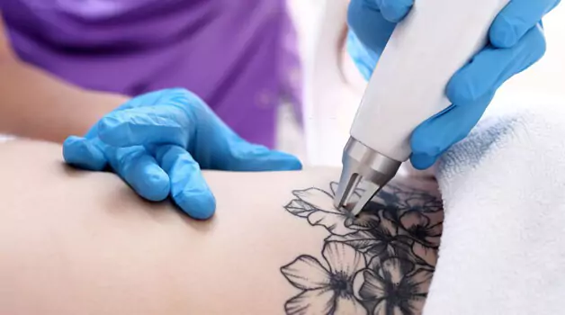 Healing process & time for laser tattoo removal
