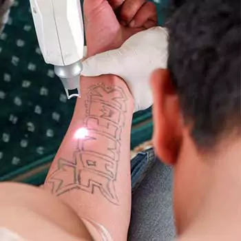 Laser tattoo removal
