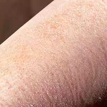 Skin flaking and fragile skin