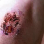 Tattoo scab came off and no ink underneath