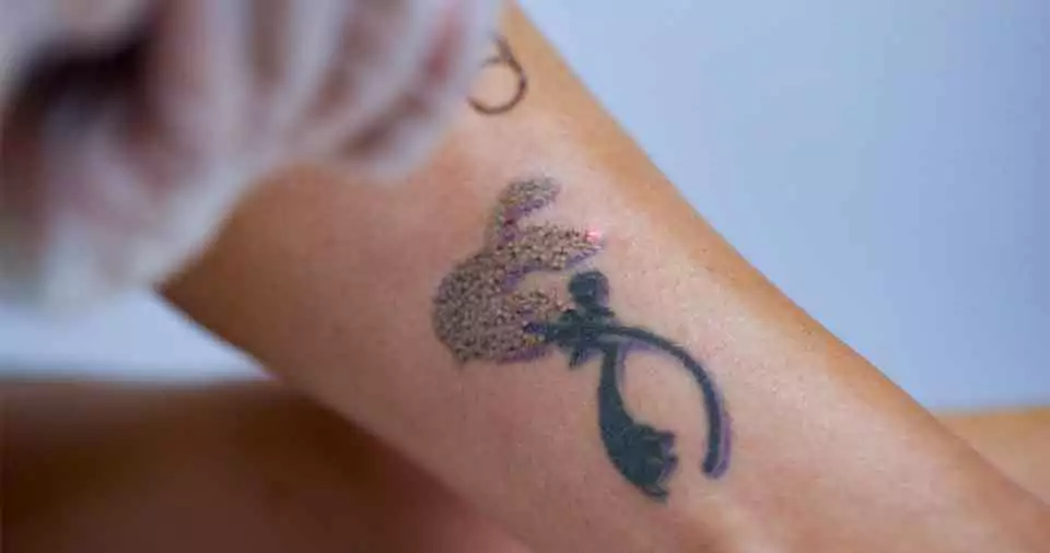 What does a tattoo look like after laser removal
