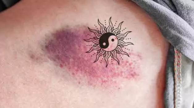 Getting a tattoo over a bruise
