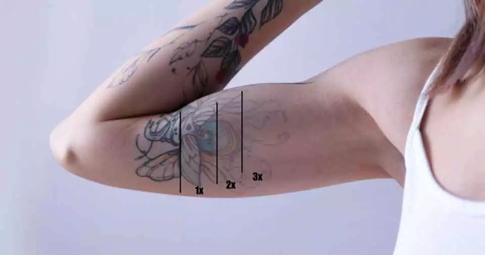 How Many sessions does it take to remove a tattoo