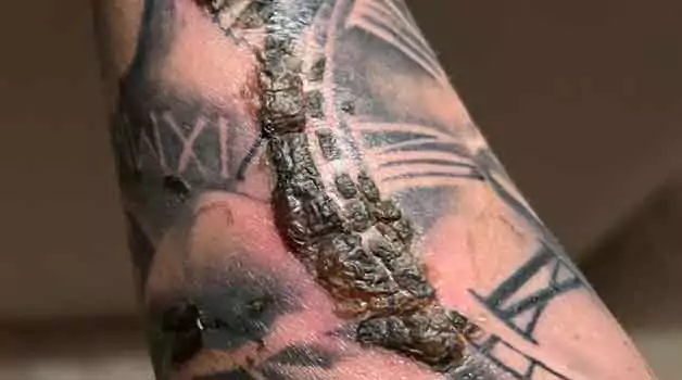 Tattoo bubbling Normal or a concern