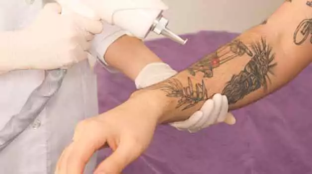 Time a tattoo removal session takes
