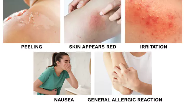 5 Side effects of aspercrème