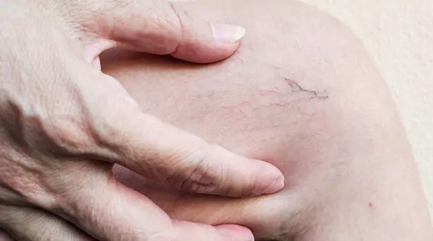 Can needle transfer ink into blood vessel if it penetrates too deep