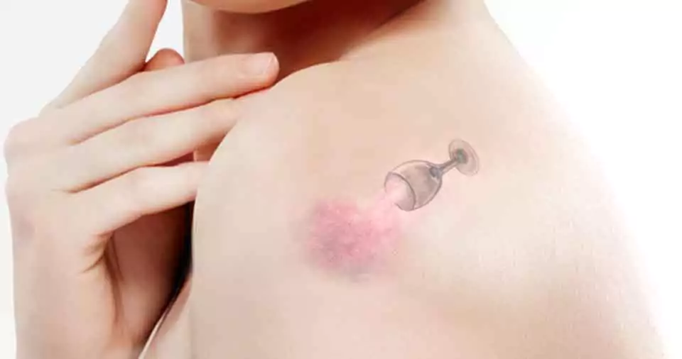 Can you tattoo over a birthmark