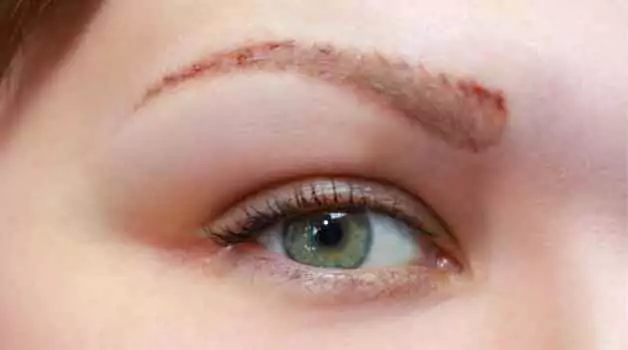 How Long does it take to heal eyebrow after tattoo removal