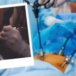 How Soon after laparoscopic surgery can I get a tattoo