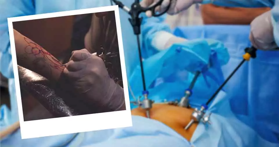 How Soon after laparoscopic surgery can I get a tattoo