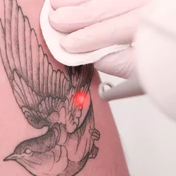 Laser removal and re-inking