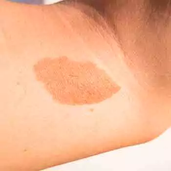 Pigmented birthmarks