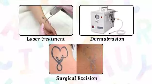 3 Ways to remove tattoo lettering