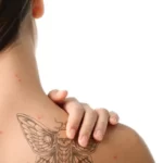 Can you tattoo over acne