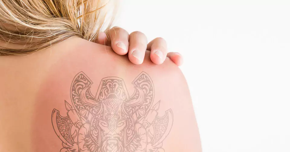 How Long after a sunburn can you get a tattoo