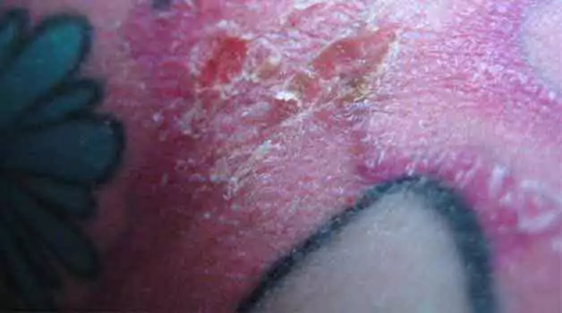 Tattoo scabbing & infection
