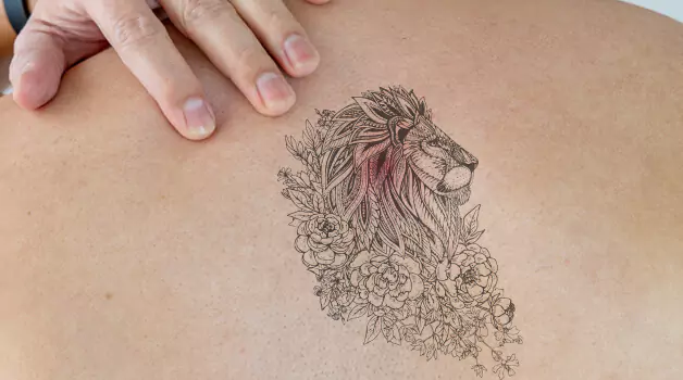 getting-tattoo-to-cover-acne-scars