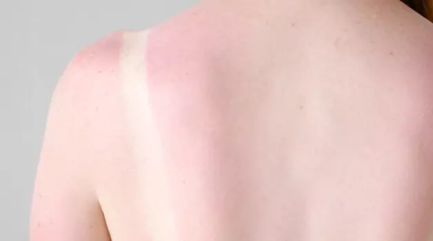 reasons-to-wait-after-a-sunburn-to-get-a-tattoo