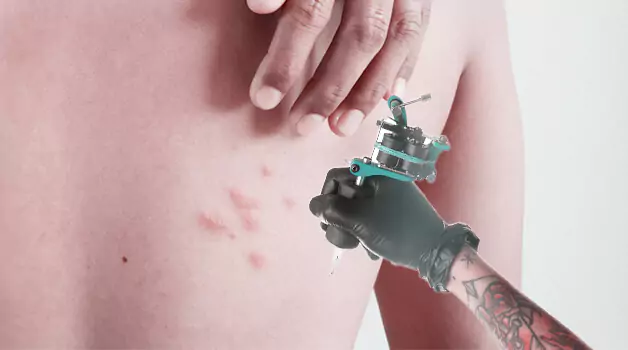 risks-limitations-when-you-get-tattoo-over-acne