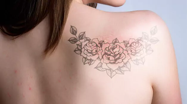 tattoo-acne-affecting-skin