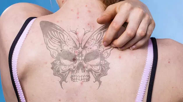 tattoo-over-acne