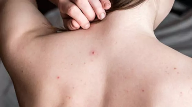 ways-to-prepare-acne-prone-skin-for-tattooing