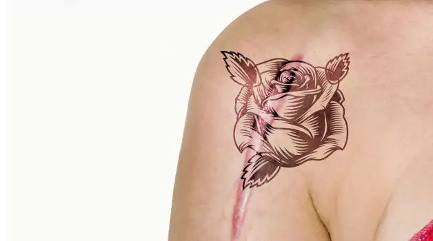 7 Ways-to-prevent-keloid-after-tattoo