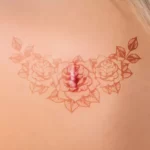 Can you get a tattoo with keloid skin