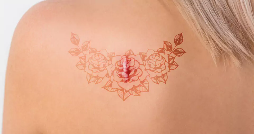 Can you get a tattoo with keloid skin