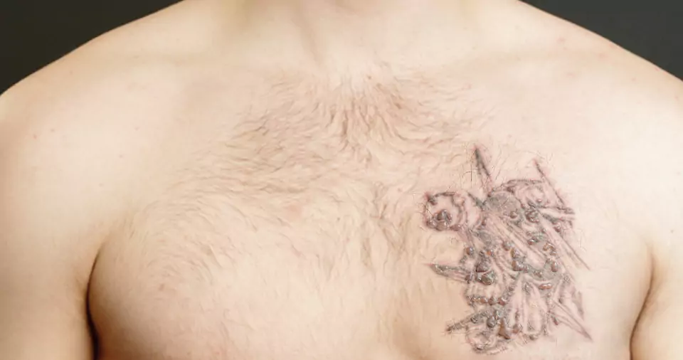 How to reduce swelling on tattoo