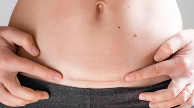 stomach-tattoo-to-cover-scars