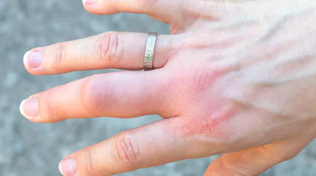 7 ways to tell if your finger tattoo got an infection