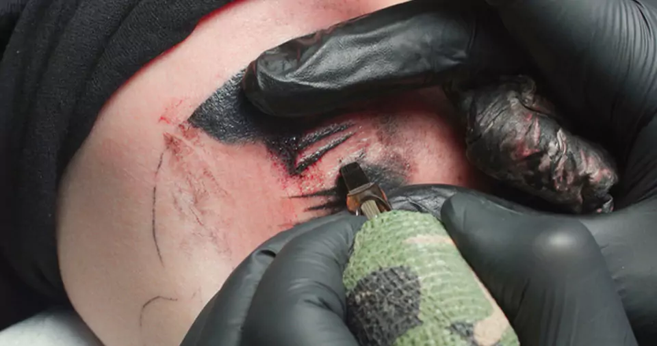 Can you tattoo over nexplanon