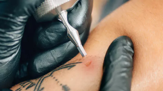 Tattoo over a mosquito bite can you do it or not