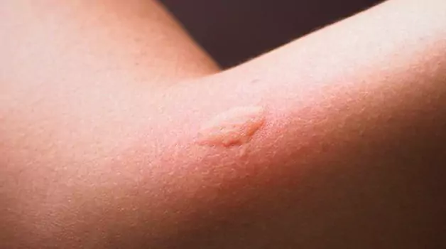 Understanding mosquito bite